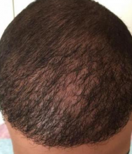 izmir-turkey-hair-transplant