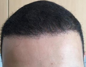 izmir-turkey-hair-transplant