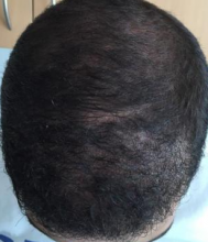 izmir-turkey-hair-transplant