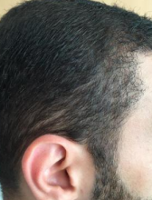 izmir-turkey-hair-transplant