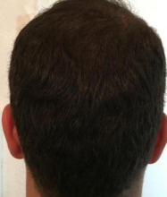 izmir-turkey-hair-transplant
