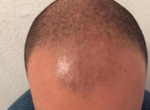 izmir-turkey-hair-transplant