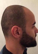izmir-turkey-hair-transplant