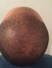 izmir-turkey-hair-transplant