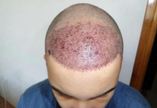 izmir-turkey-hair-transplant