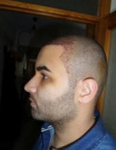 izmir-turkey-hair-transplant