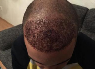 izmir-turkey-hair-transplant