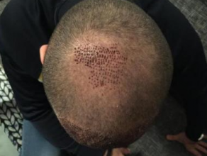izmir-turkey-hair-transplant