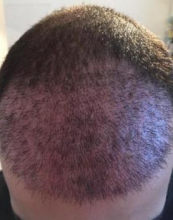 izmir-turkey-hair-transplant