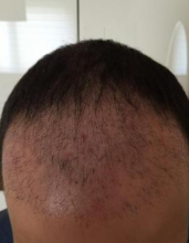 izmir-turkey-hair-transplant