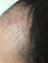 izmir-turkey-hair-transplant