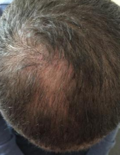 izmir-turkey-hair-transplant
