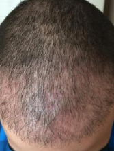 izmir-turkey-hair-transplant
