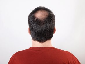 hair loss