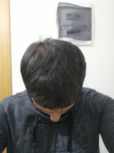 serdar-gokrem-3300-grafts
