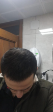 serdar-gokrem-3300-grafts