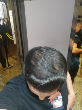 serdar-gokrem-3300-grafts