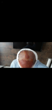 serdar-gokrem-3300-grafts
