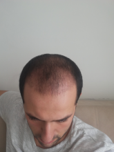 serdar-gokrem-3300-grafts
