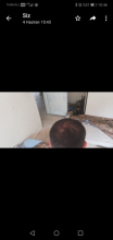 serdar-gokrem-3300-grafts