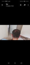 serdar-gokrem-3300-grafts