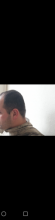serdar-gokrem-3300-grafts