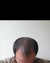 serdar-gokrem-3300-grafts