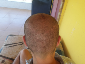 serdar-gokrem-3300-grafts