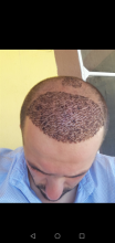 serdar-gokrem-3300-grafts