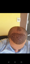 serdar-gokrem-3300-grafts