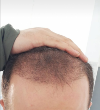 serdar-gokrem-3300-grafts