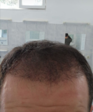 serdar-gokrem-3300-grafts