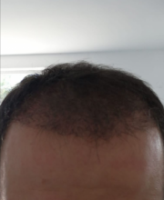 serdar-gokrem-3300-grafts