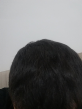 serdar-gokrem-3300-grafts