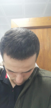 serdar-gokrem-3300-grafts