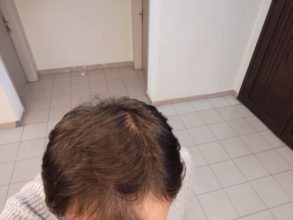 serkan-aygin-3830-grafts