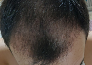 serkan-aygin-3830-grafts