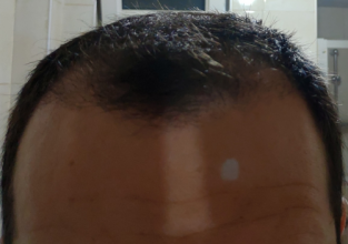 serkan-aygin-3830-grafts
