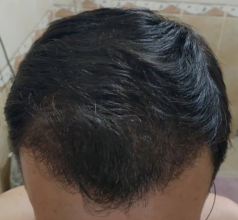 serkan-aygin-3830-grafts