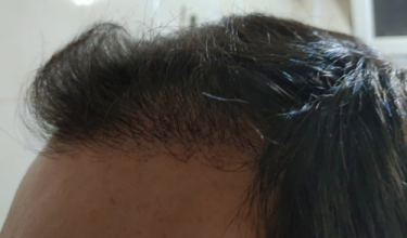 serkan-aygin-3830-grafts