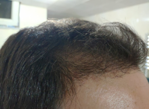 serkan-aygin-3830-grafts