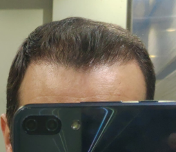 serkan-aygin-3830-grafts