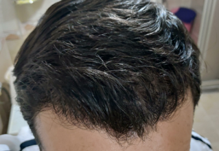 serkan-aygin-3830-grafts