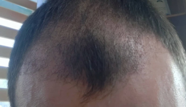 serkan-aygin-3830-grafts