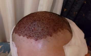 serkan-aygin-3830-grafts