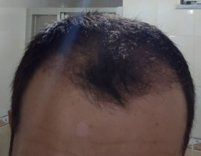 serkan-aygin-3830-grafts