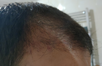 serkan-aygin-3830-grafts