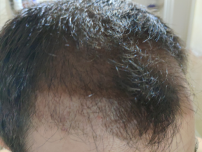 serkan-aygin-3830-grafts