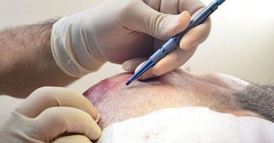 hair-transplant-price-in-ankara