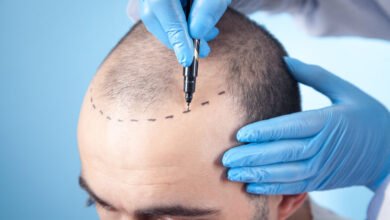 Hair loss consultation with a doctor marking the scalp